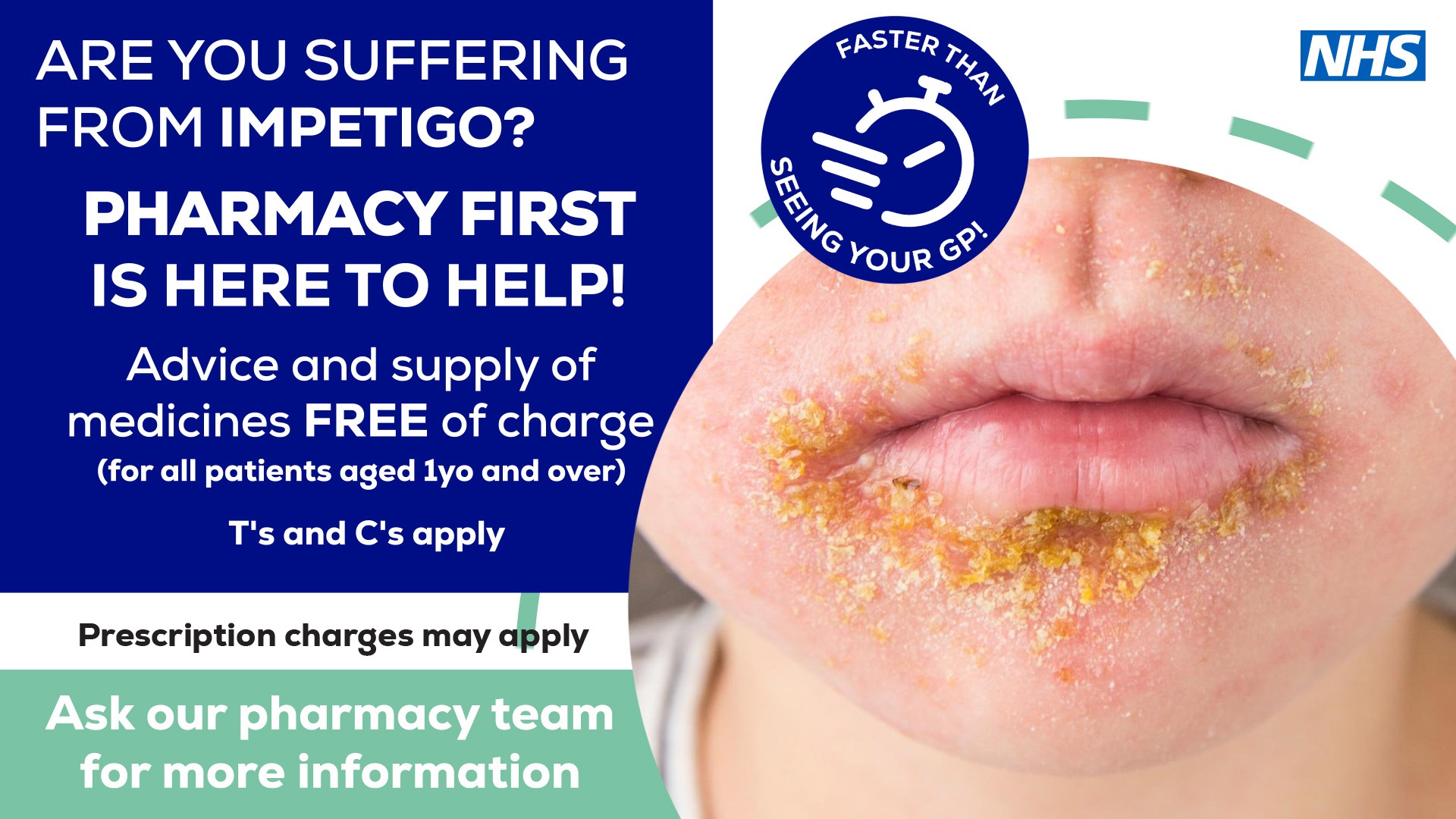 Impetigo - Pharmacy First - Earls Court - London -Zafash Pharmacy